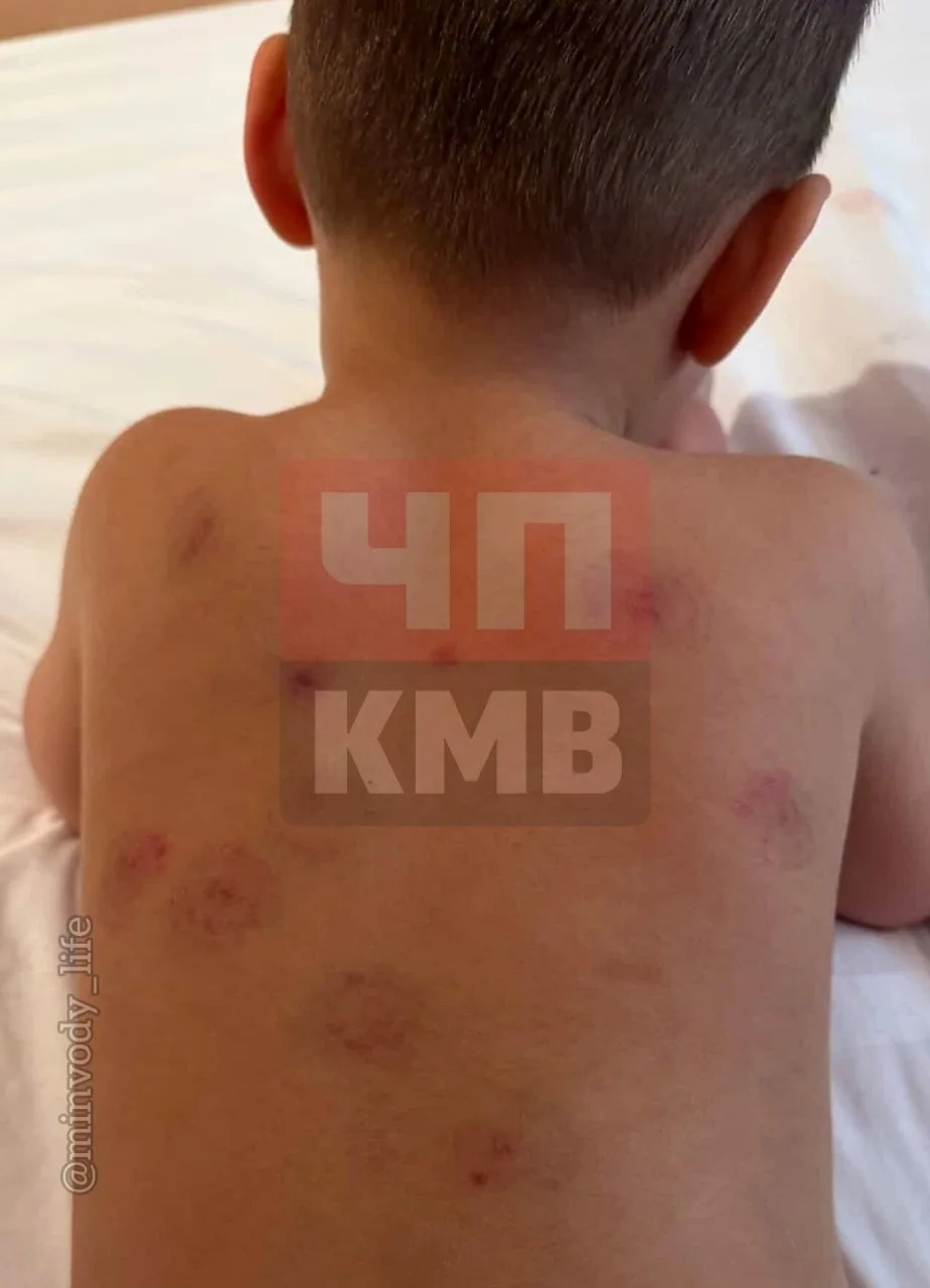 ❗️В Минераловодском округе расследуются появление укусов у ребенка. — пишет губернатор Владимиров.  