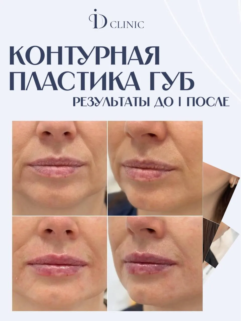 Контурная пластика губ — результаты ДО | ПОСЛЕ🫦