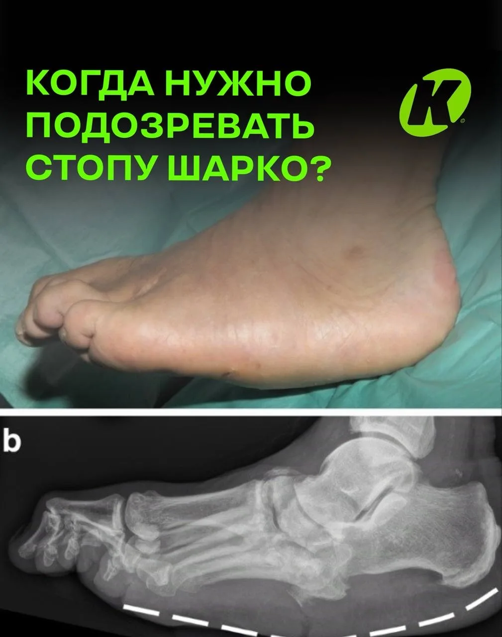 Когда нужно подозревать стопу Шарко?

На ранних этапах заболевание нередко ошибочно принимают за:
 •