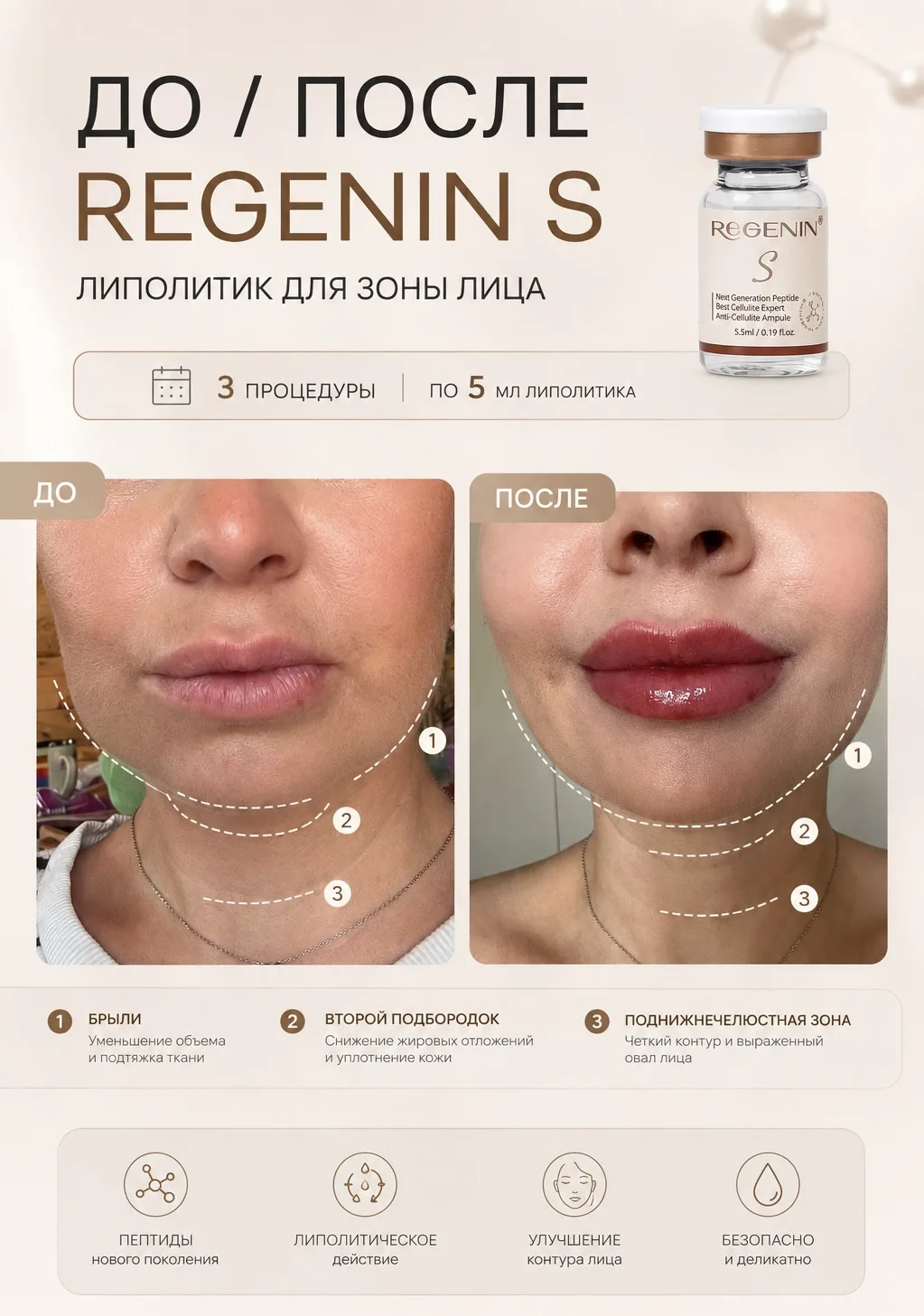 5 причин выбрать REGENIN S для деликатной коррекции лица