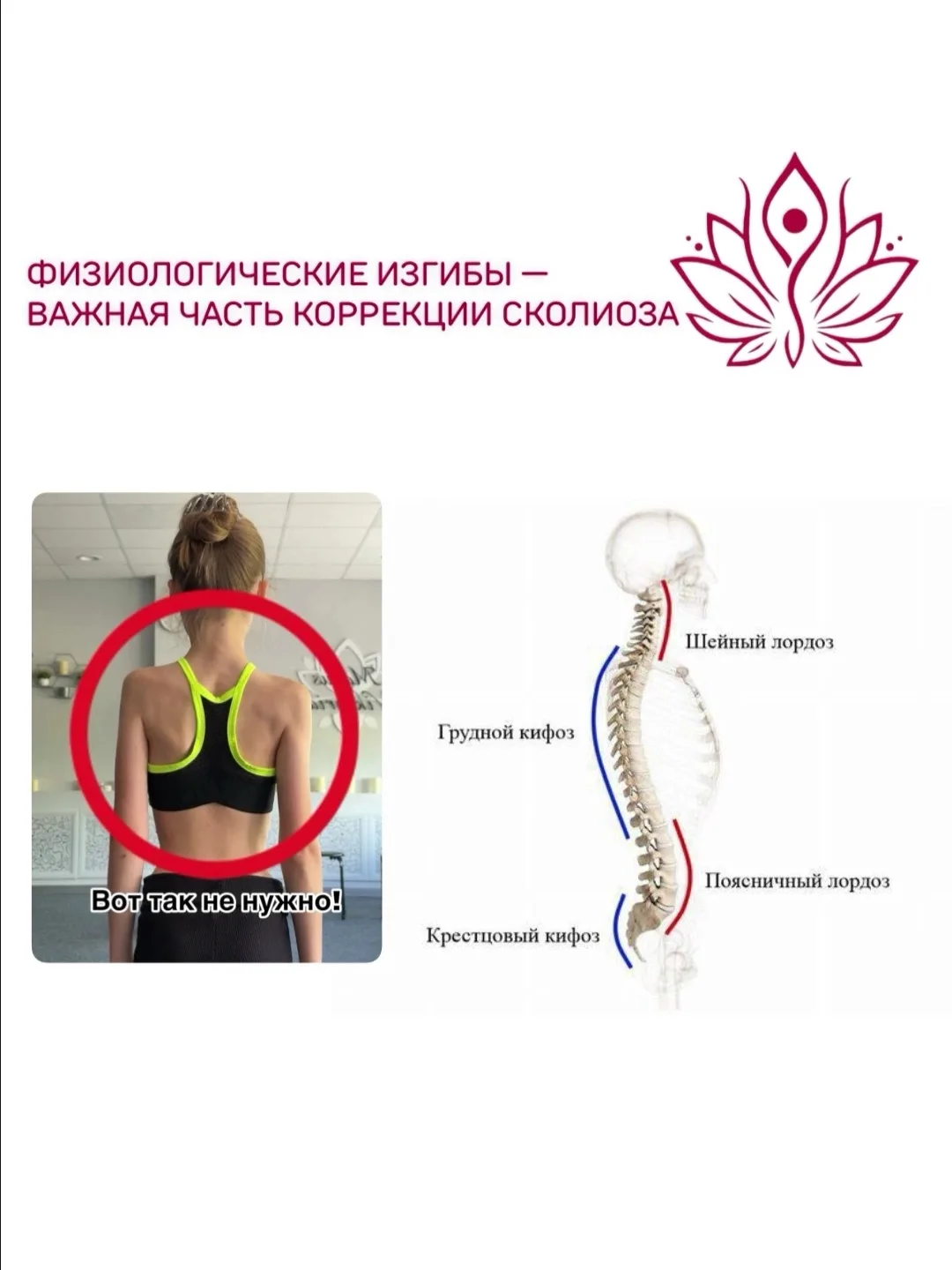 ФИЗИОЛОГИЧЕСКИЕ ИЗГИБЫ — важная часть коррекции сколиоза