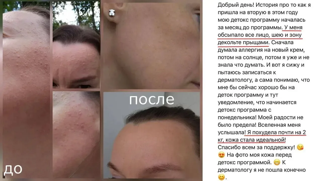 Акне принято считать подростковой проблемой.
