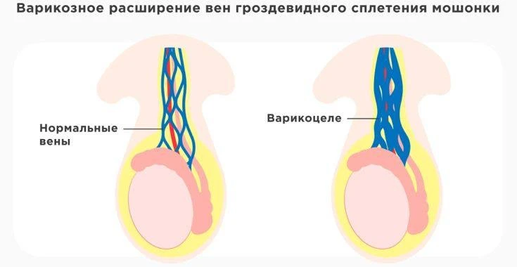 Варикоцеле. Нужно ли делать операцию?  Варикоцеле это расширение вен вокруг яичка. По сути это тот ж