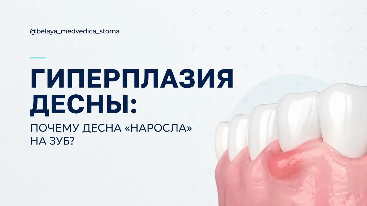 🏥 Гиперплазия десны: почему десна «наросла» на зуб?

Если вам кажется, что десна стала больше и нач