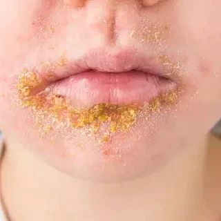 Импетиго: странные корочки у ребёнка?