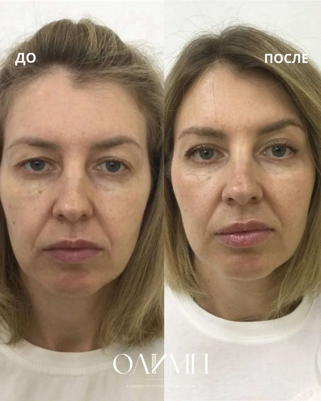Была выполнена верхняя блефаропластика.