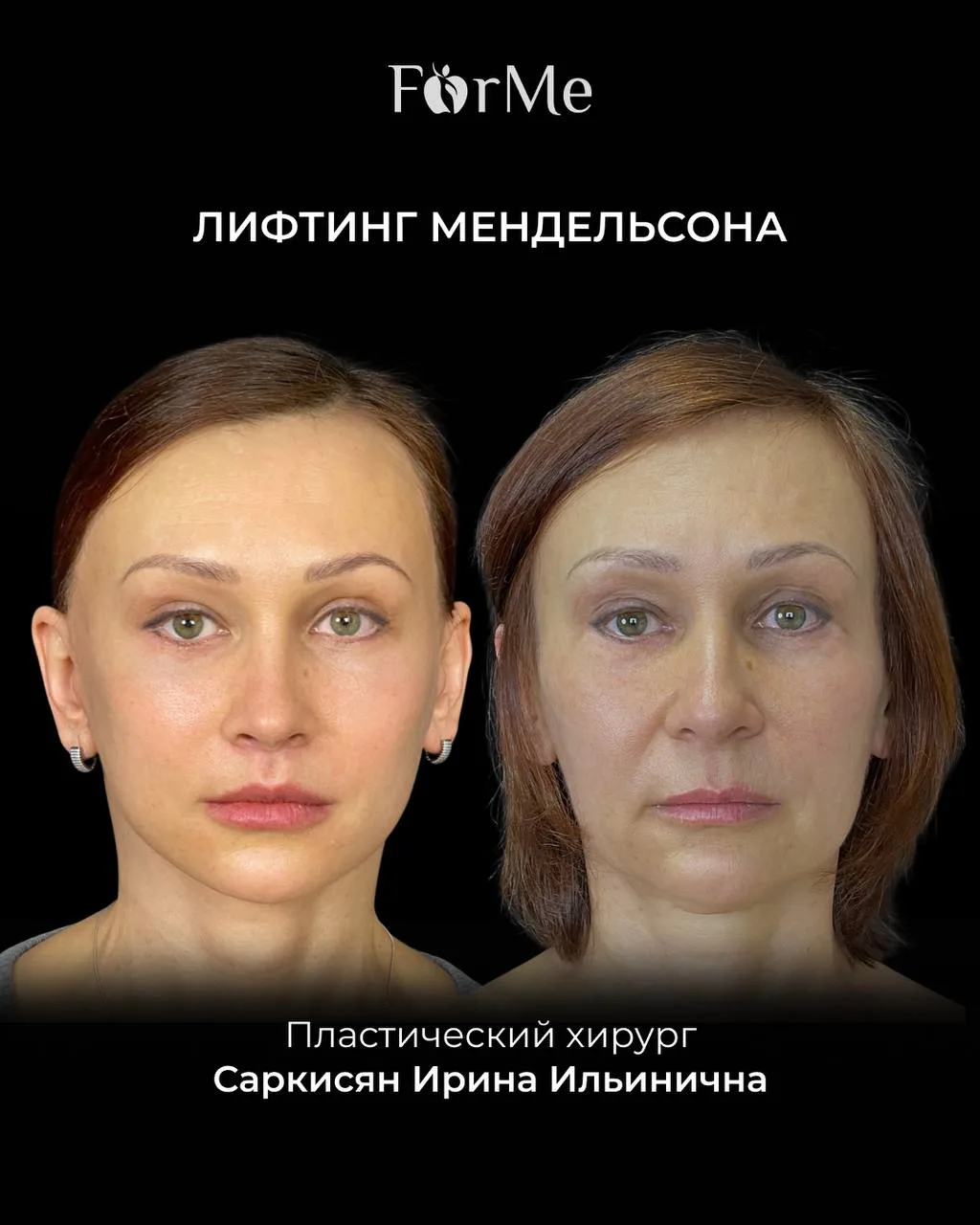 Выполнена операция лифтинга Мендельсона пластическим хирургом Саркисян Ириной Ильиничной! 

Лифтинг 