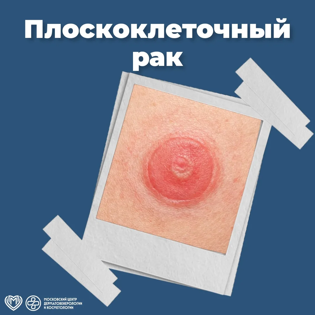 🔎 Плоскоклеточная карцинома кожи (ПКК) – это злокачественное новообразование, развиваю...