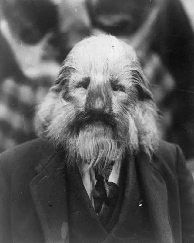 Стефан Бибровски – «человек с львиным лицом». 1910 г., Польша

Стефан Бибровски, родившийся в 1890 г