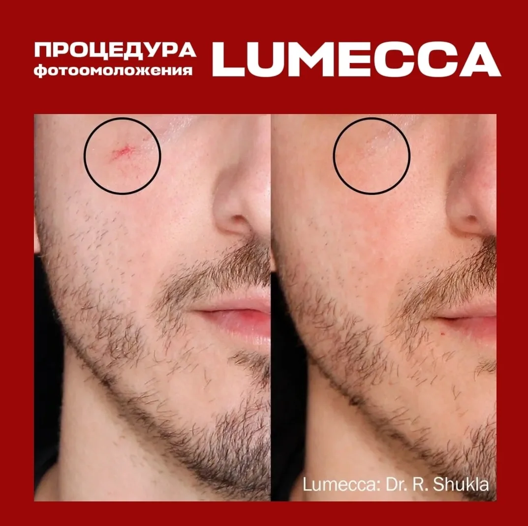 Lumecca: результат на лицо… на руки и шею!
