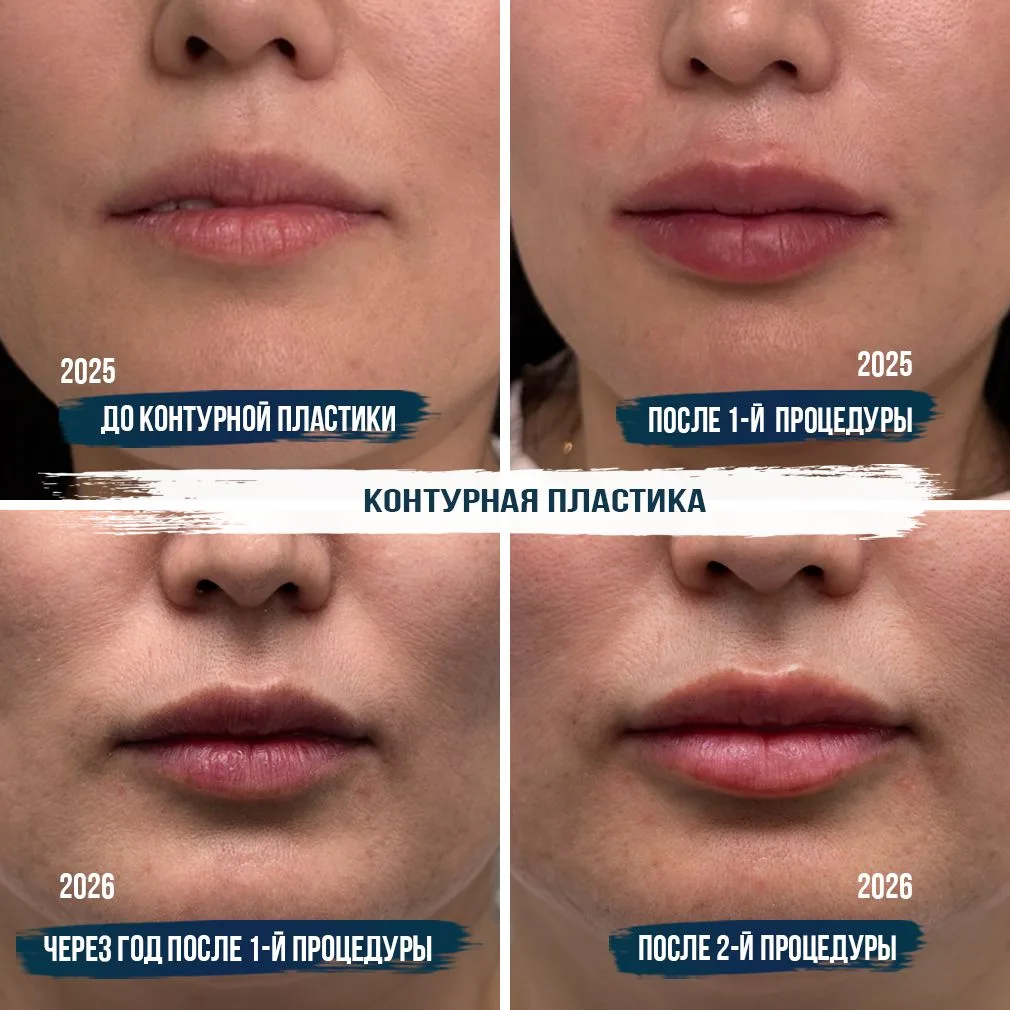 Как выглядят губы через год после контурной пластики?
