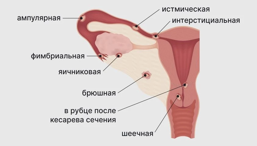 💔Когда запрет становится угрозой для жизни.

На 10-й неделе беременности у 43-летней жительницы Фло