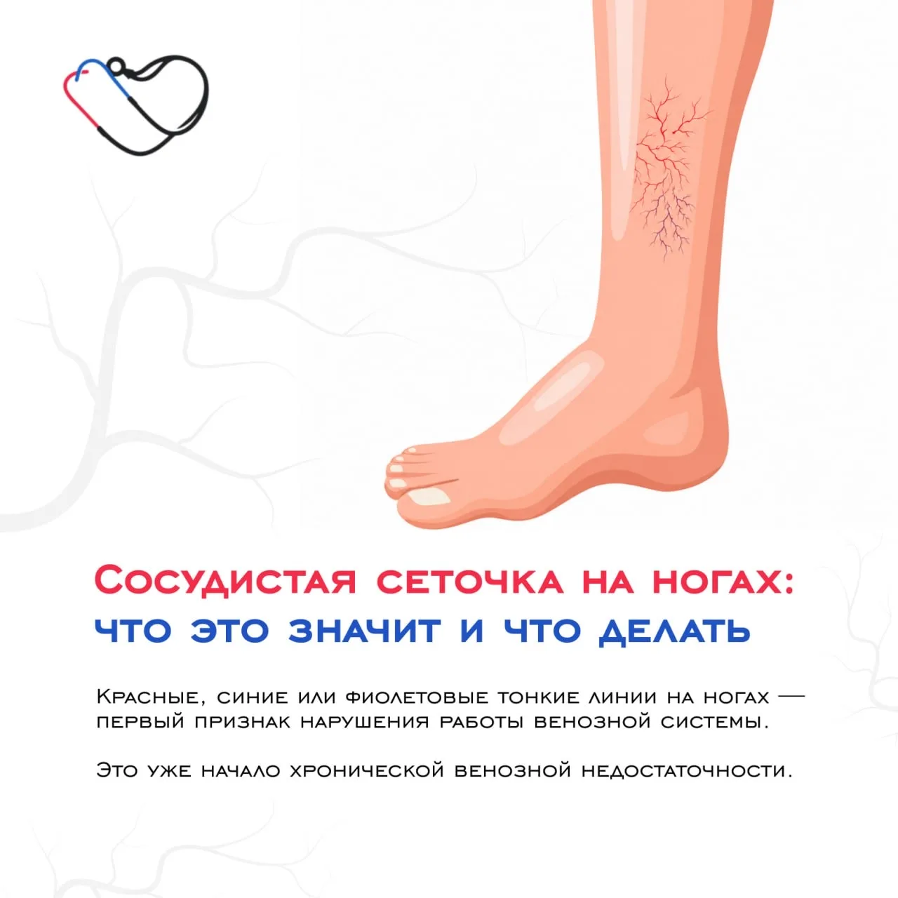 ➡️Сосудистая сеточка на ногах: что это значит и что с ней делать?