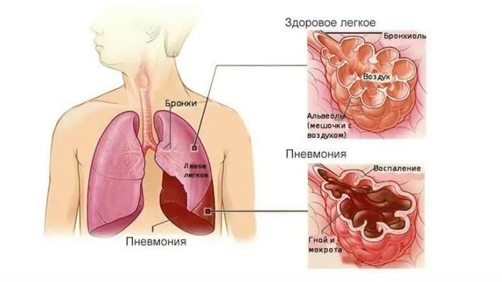 Пневмония — меры профилактики