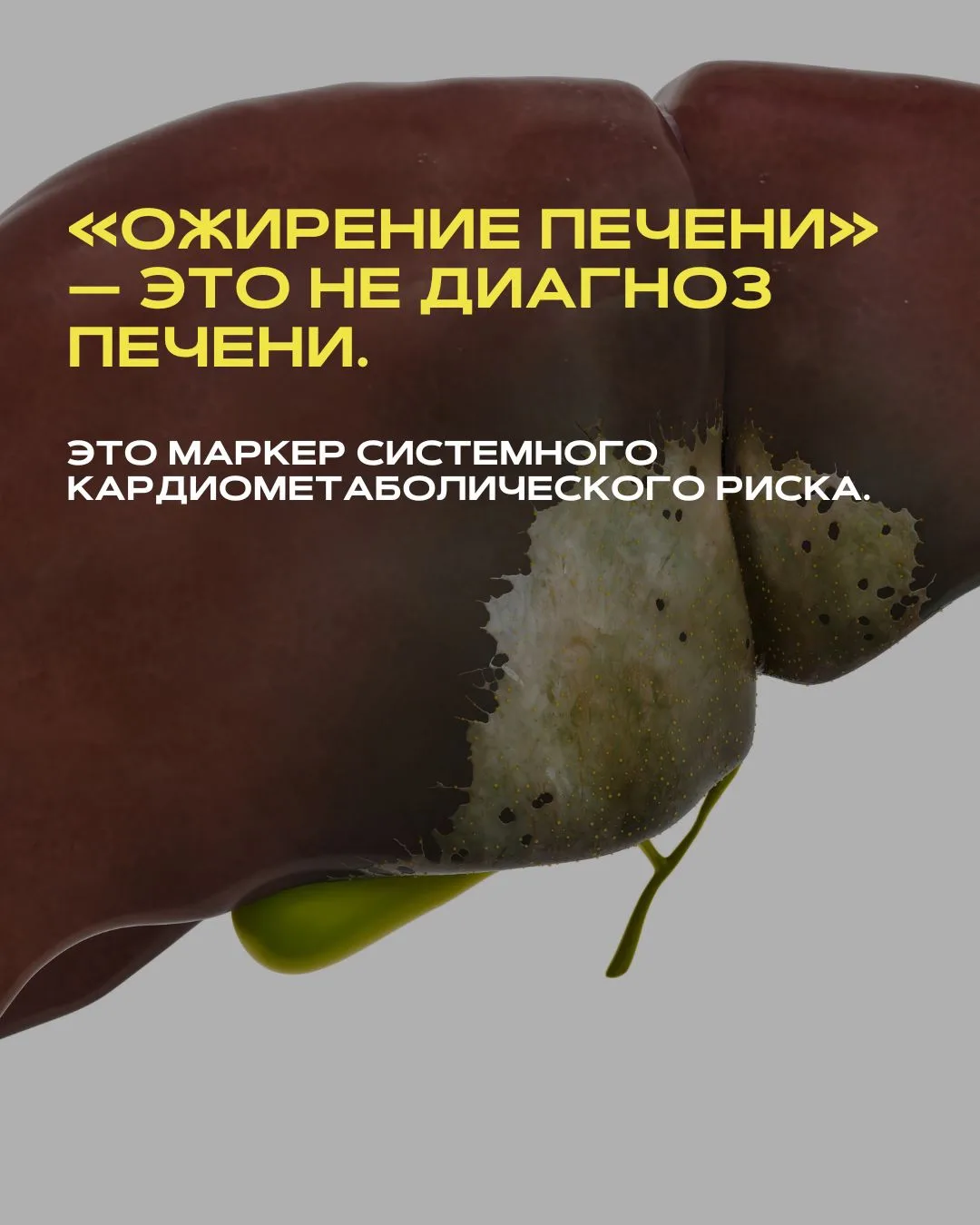 «Ожирение печени» это не диагноз печени. Это маркер системного кардиометаболического риска.

Стеатоз