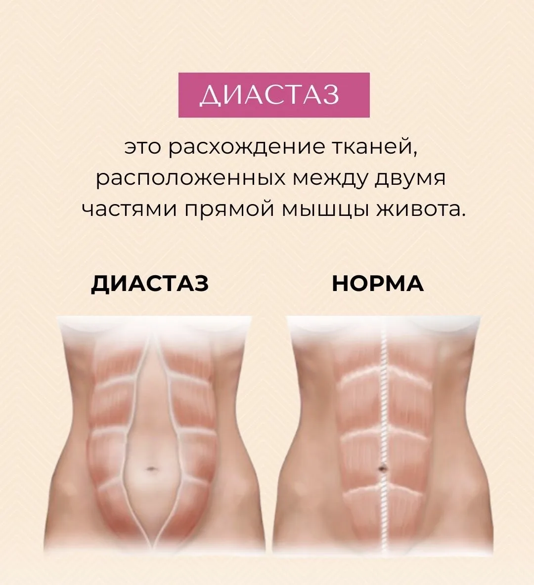 Что такое диастаз после родов?