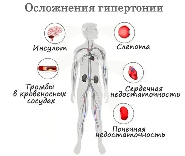Осложнения гипертонической болезни