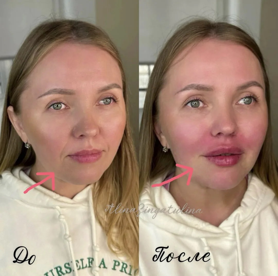 Коррекция носогубных складок ✨