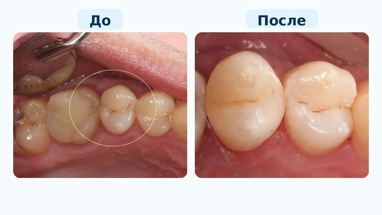 🦷 Примерьте на себя роль стоматолога!

Перед вами этапы одного клинического случая. Сможете расстав