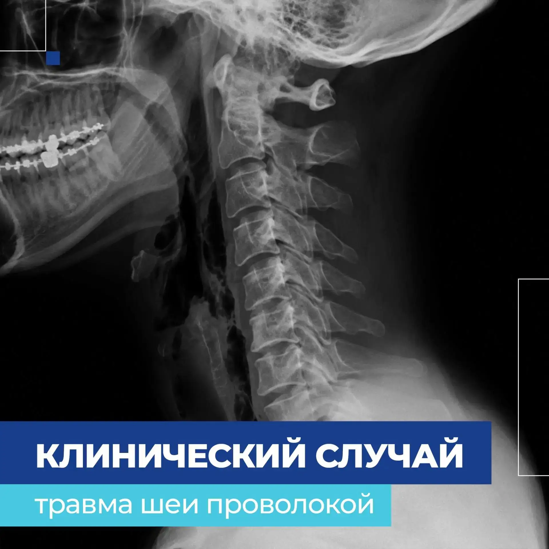 🧑‍⚕️Чудом не истёк кровью: хирурги ЧОДКБ спасли подростка

В Челябинскую областную детскую клиничес