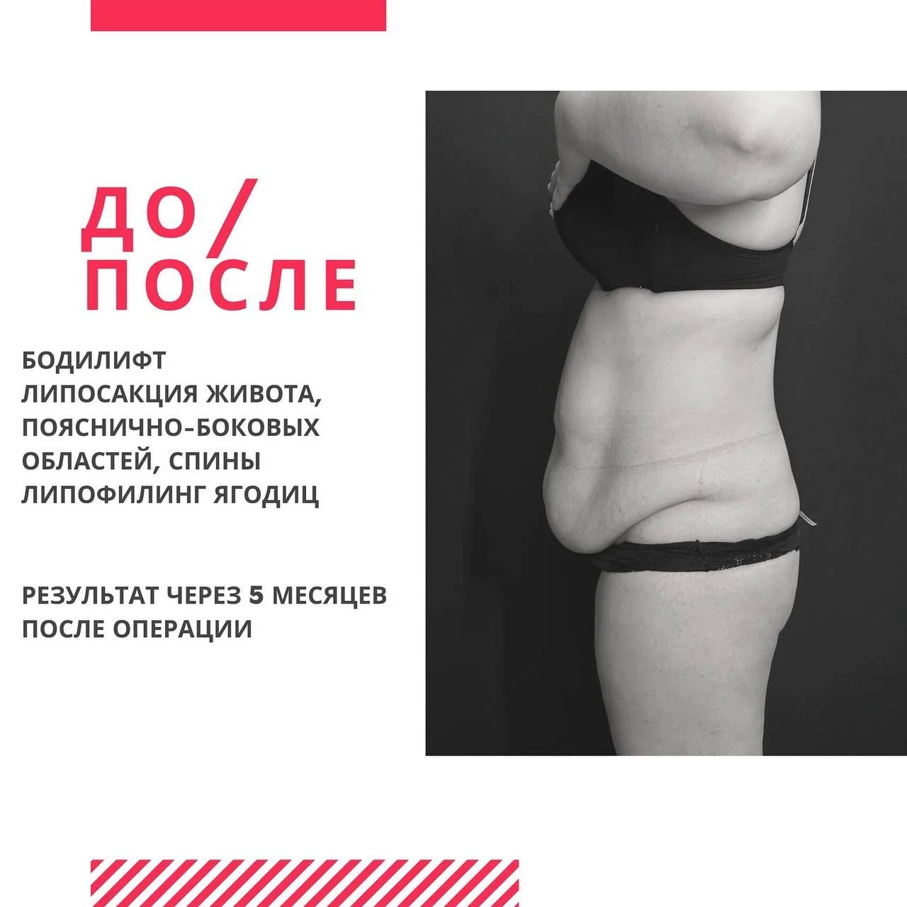 Сама операция бодилифт достаточно эффективна, но в сочетании с круговой липосакцией и л...