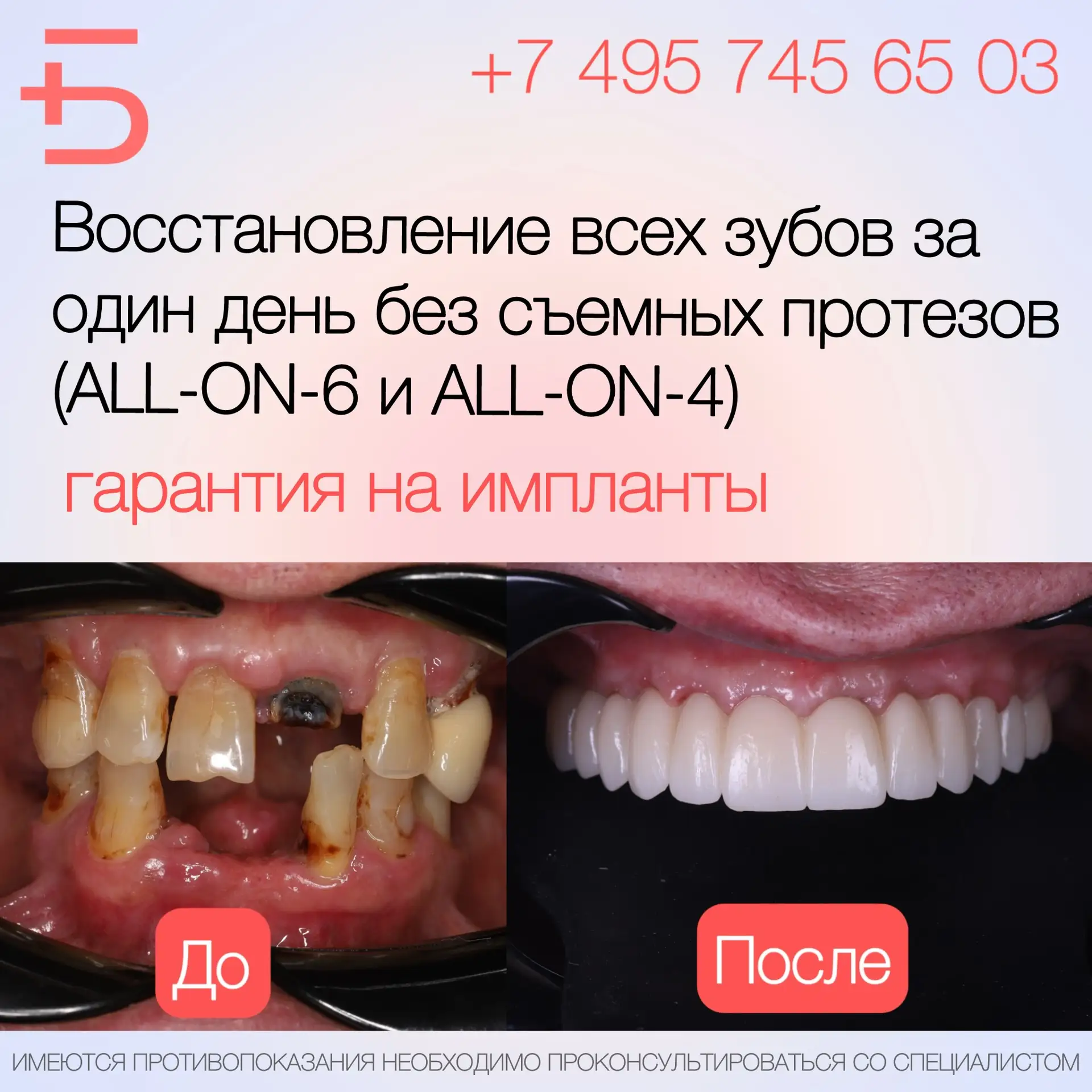 У съёмных протезов есть ряд достаточно серьёзных минусов: ➖ Психологически, далеко не все пациенты г