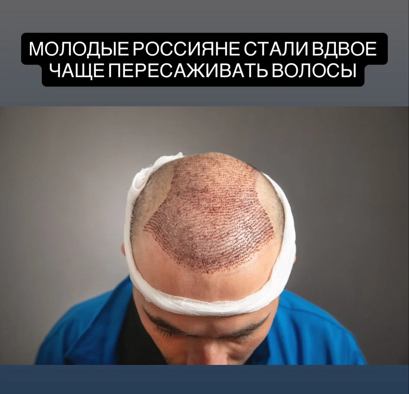 В 2025 году спрос на пересадку волос среди россиян до 35 лет вырос вдвое. Молодые пацие...