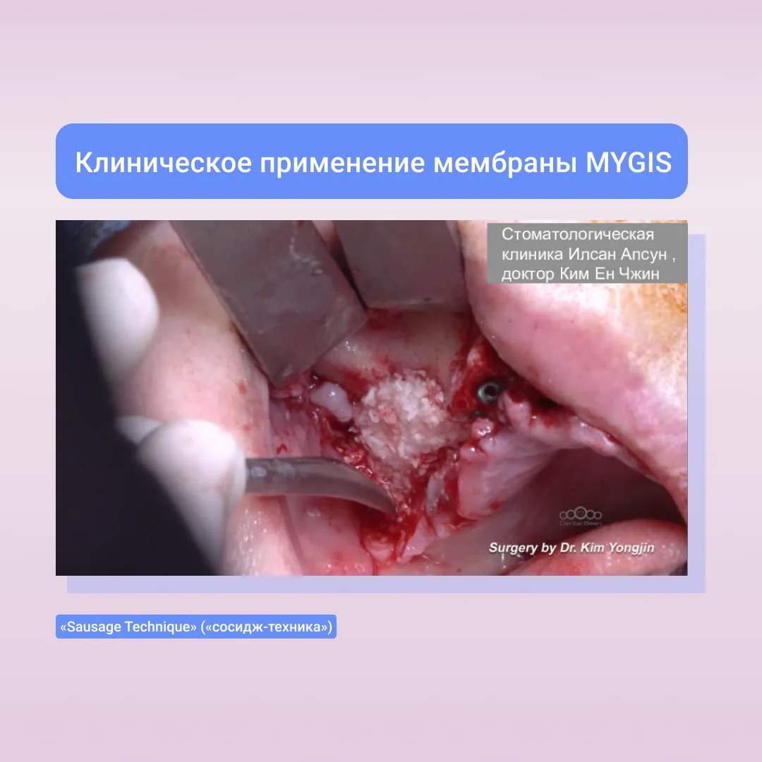 🦷От теории к практике: клиническое применение мембраны MYGIS.