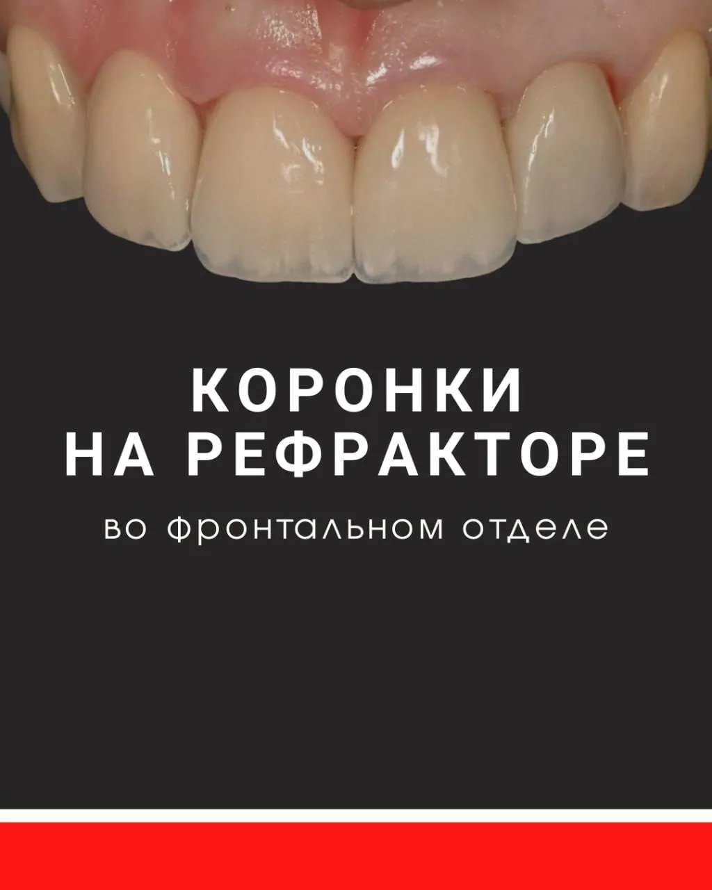 4 фронтальные коронки на рефракторе, одна из них на имплантате, 3 - на своих зубах👌