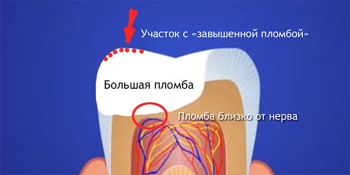 Поставили пломбу, а зуб ноет при накусывании. Паника: «Доктор запорол».   Спокойно. Постпломбировочн