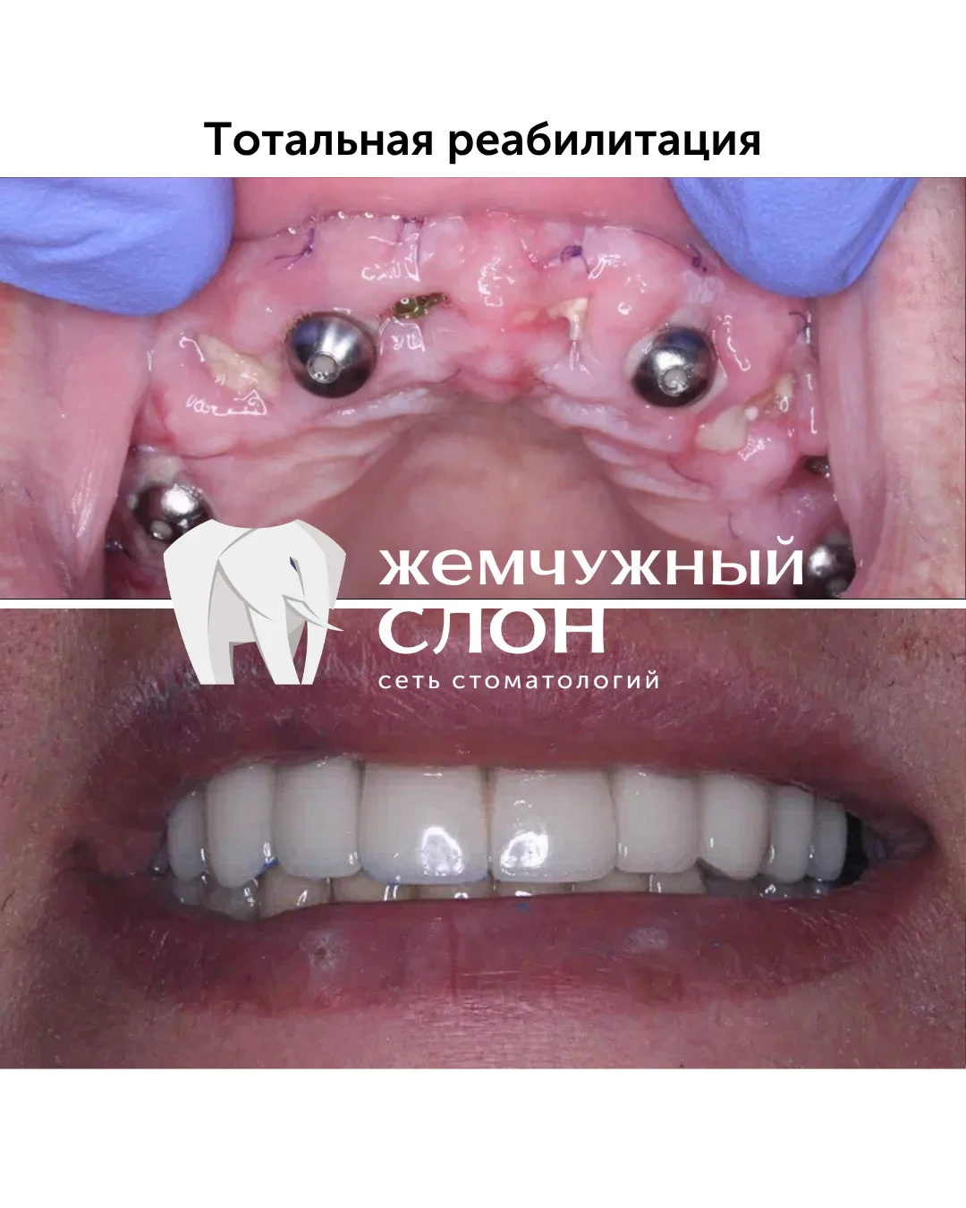 Пациентка обратилась с запросом на полное восстановление зубного ряда. Состояние «до» —...