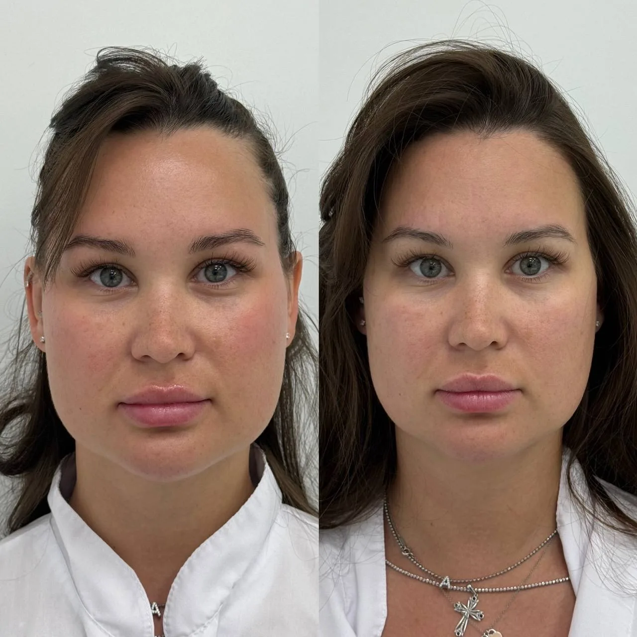 ✨ SMAS-лифтинг на Face Sculptor: результат уже после первой процедуры