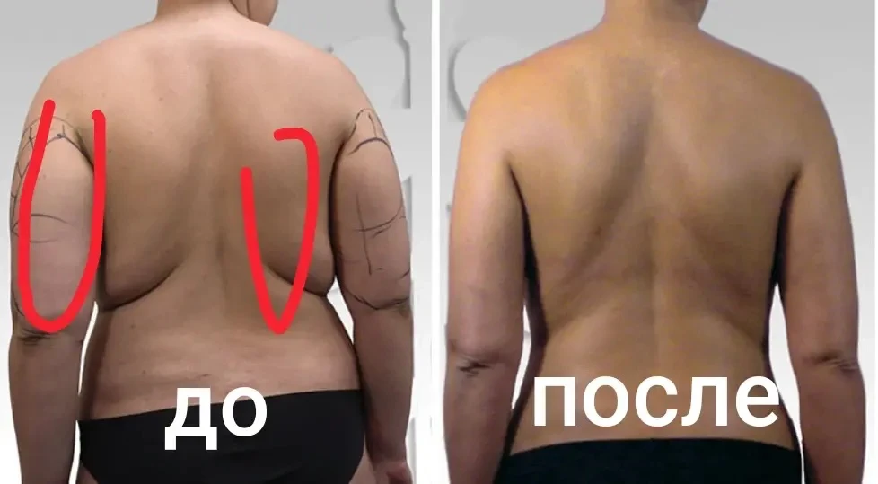 Завтра ❗️Требуется модель на ручную липопластику.