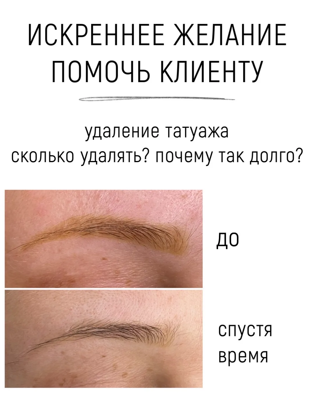 Теперь про удаление татуажа