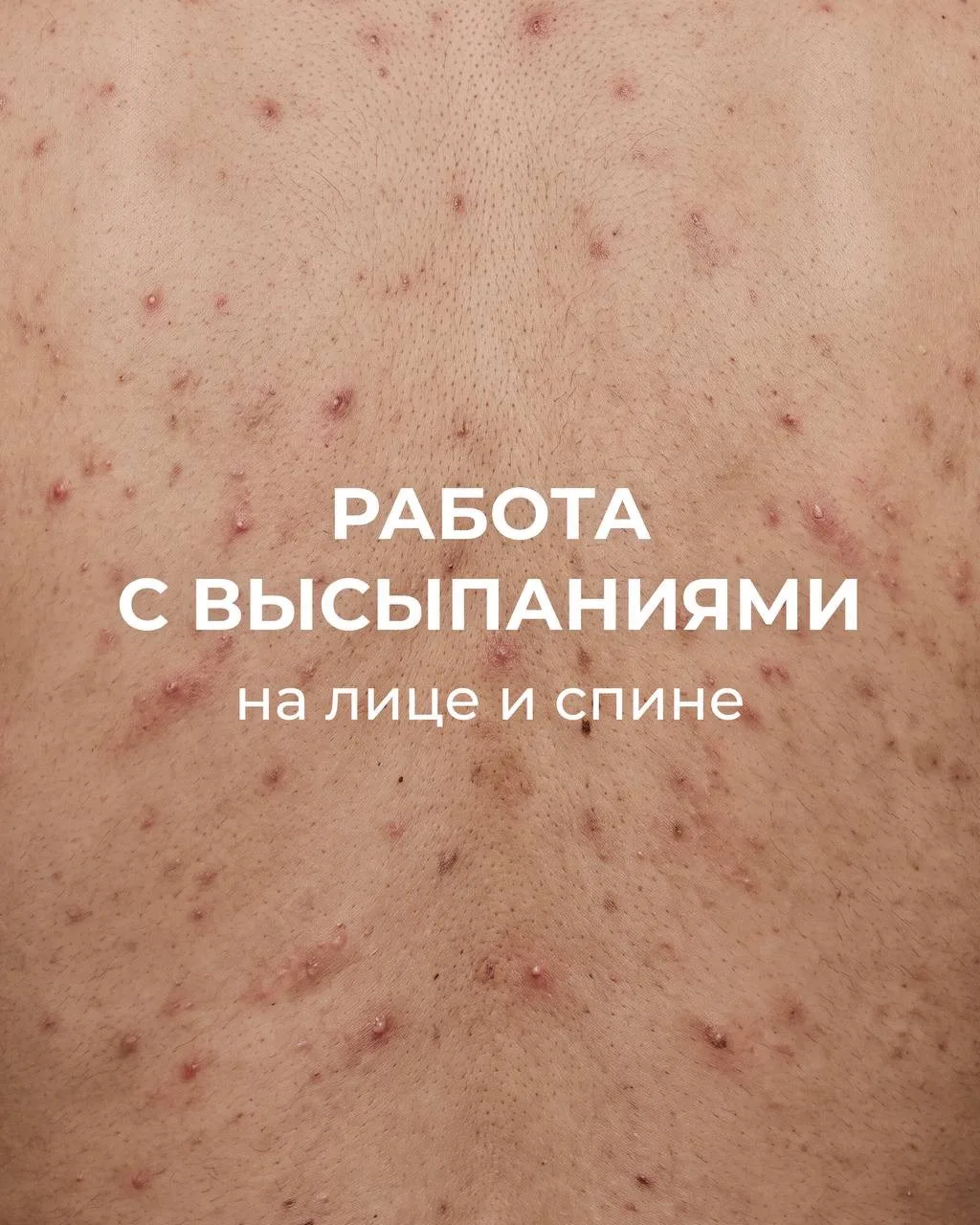 Полтора года высыпаний на лице и спине: как выстроили лечение