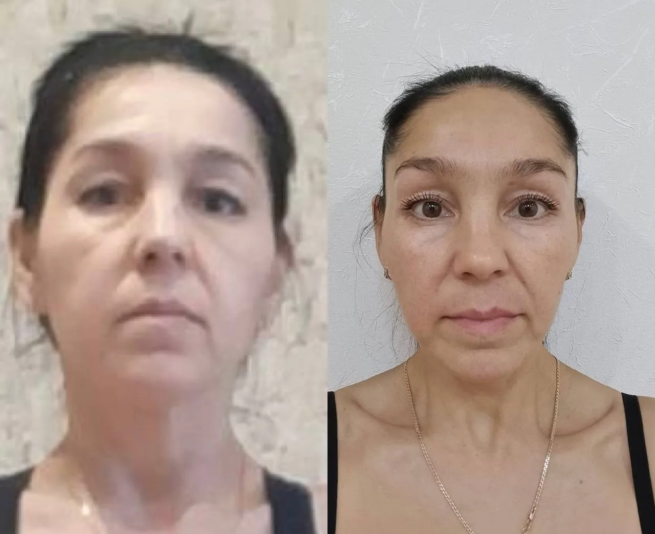 Шейные позвонки и АСИММЕТРИЯ ЛИЦА, в чем связь?   Да, лица каждой из нас немного асимметричны - и эт