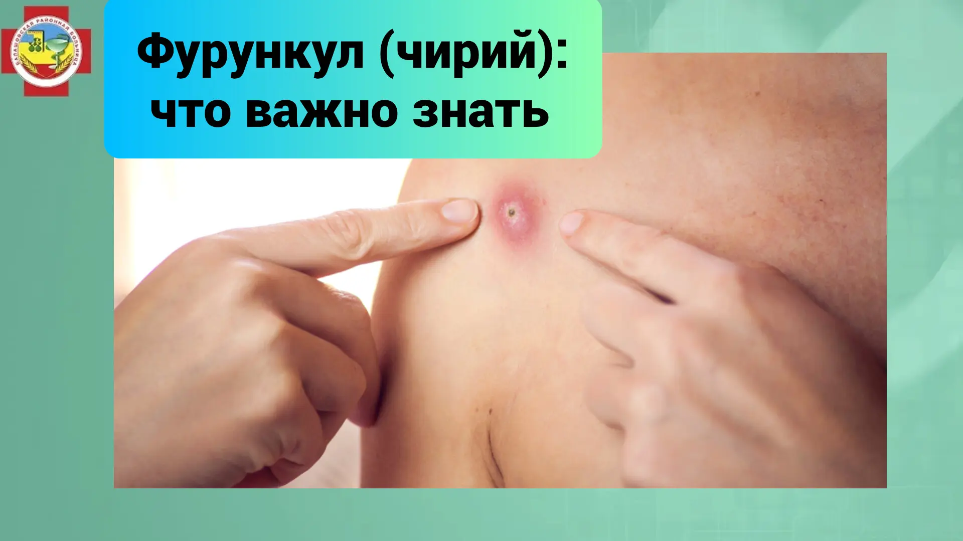 Чирий, или по-медицински фурункул, - это острое гнойное воспаление волосяного фолликула и окружающих