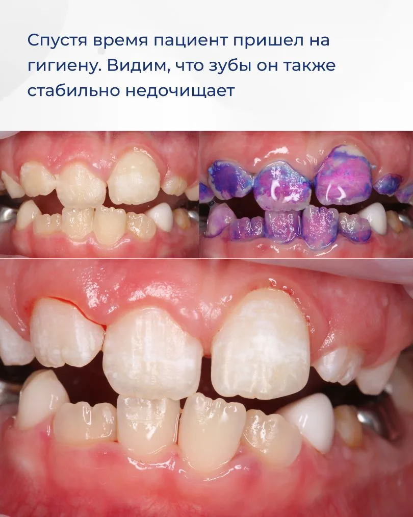 Недостаточно тщательная домашняя гигиена может привести к множественному поражению зубов. Именно это