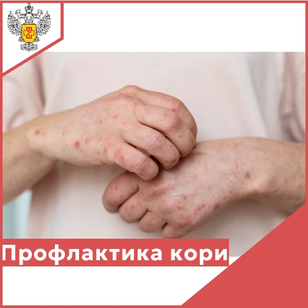 ‼️Корь – чрезвычайно заразное вирусное заболевание, передающееся воздушно-капельным путем и характер