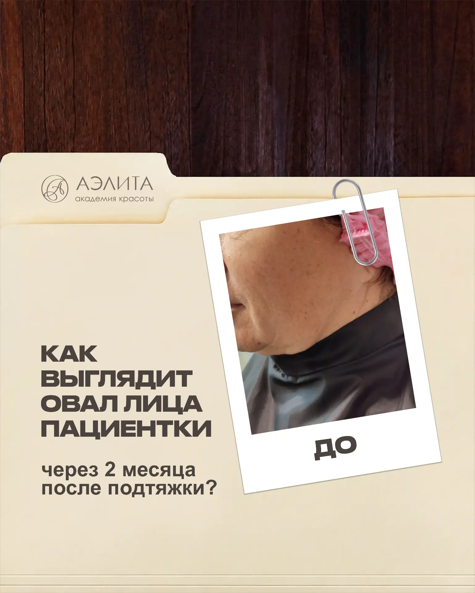 🤩Изменения овала лица через 2 месяца после SMAS-лифтинга — это постепенный, контролируемый процесс,