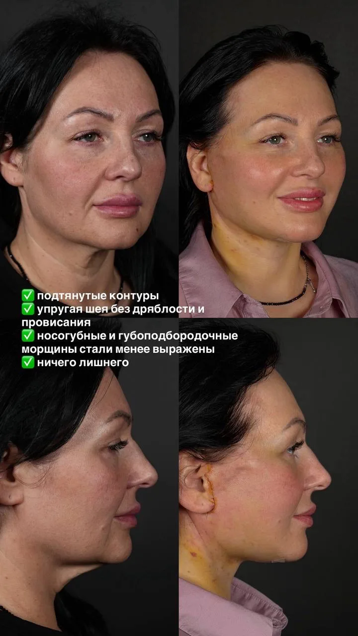 Фейслифтинг. Ранний этап реабилитации 💚