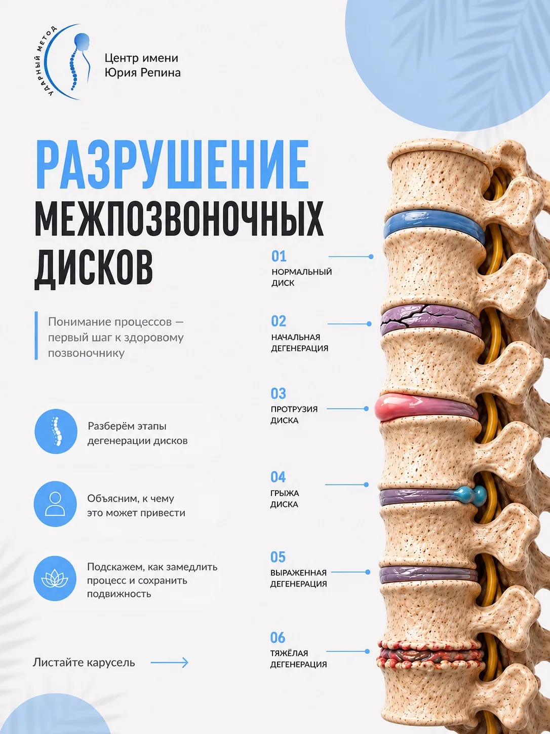 РАЗРУШЕНИЕ МЕЖПОЗВОНКОВОГО ДИСКА происходит не за один день.