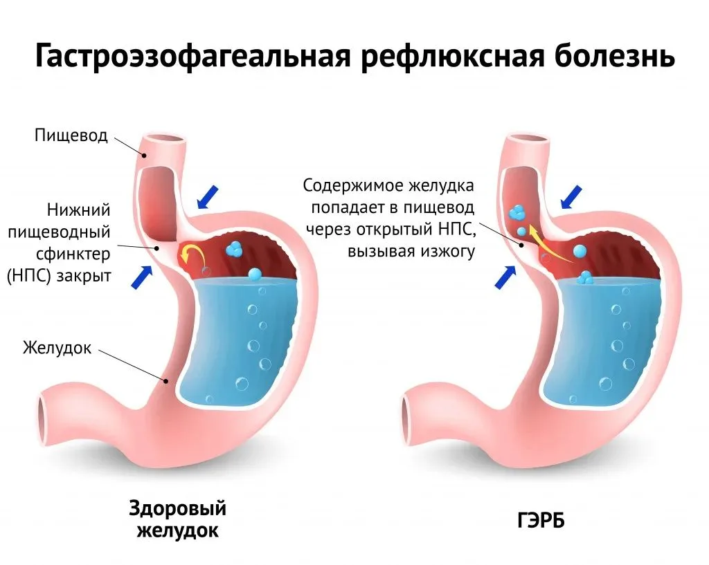 Изжога от острого — не у всех