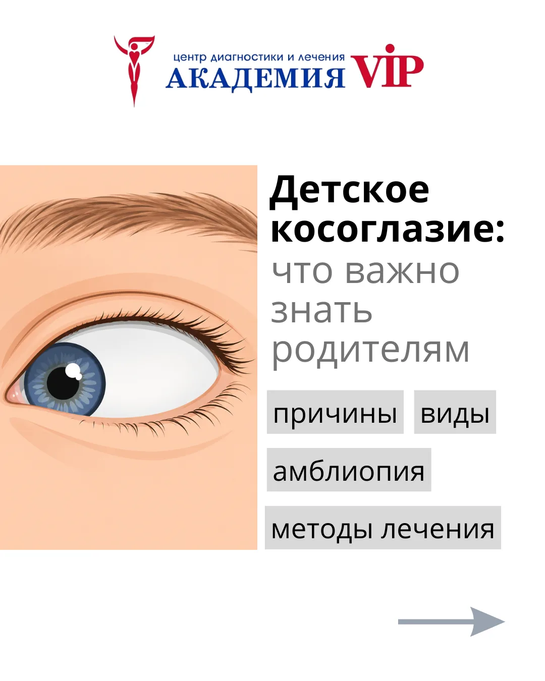 Косоглазие — это нарушение положения глаз, при котором один или оба глаза отклоняются о...