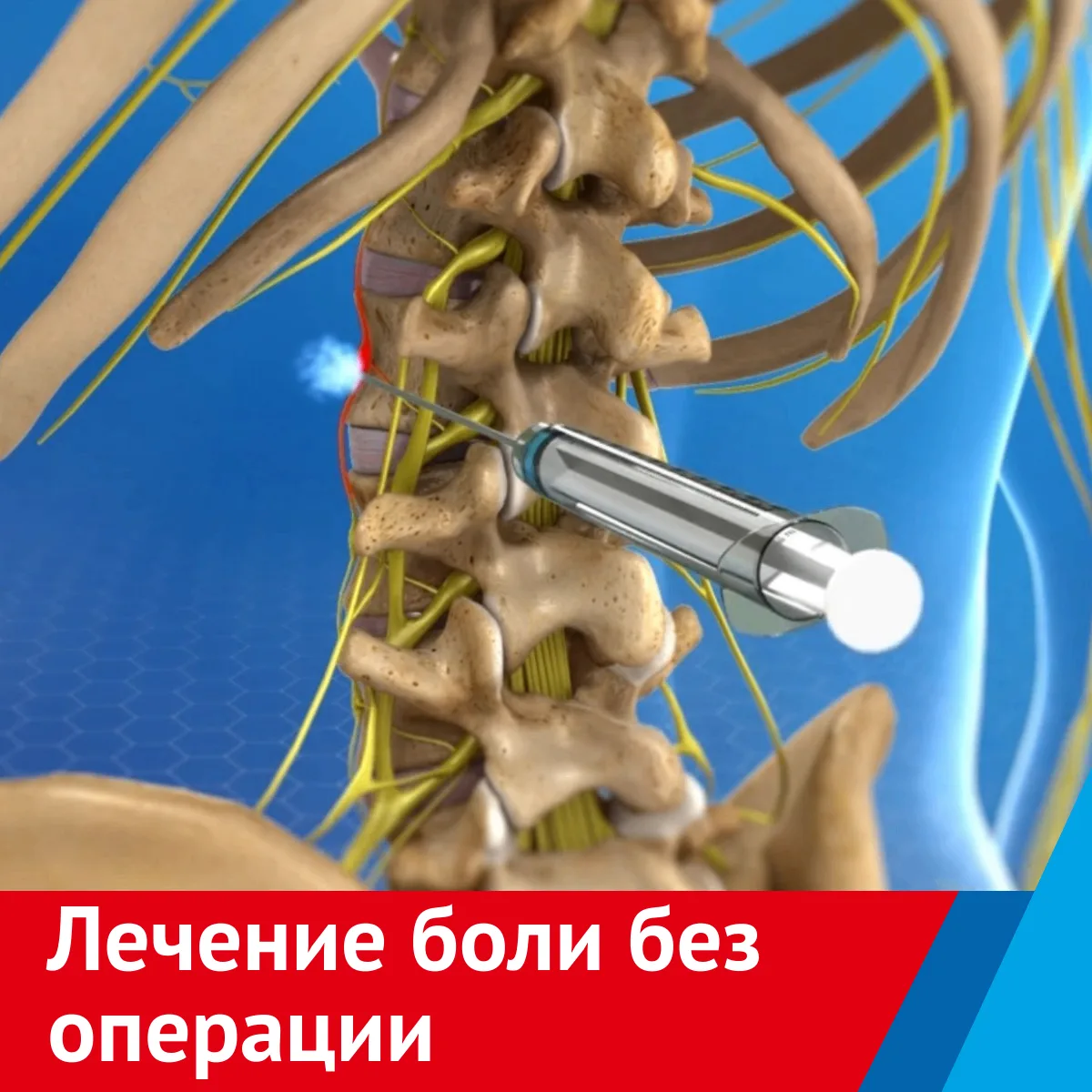 Хроническая боль в спине и суставах: устранение без операции