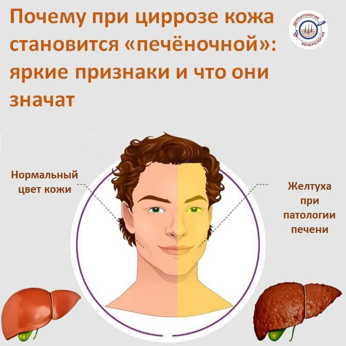 Когда цирроз печени прогрессирует, кожа становится настоящей "визитной карточкой" болезни — появляют