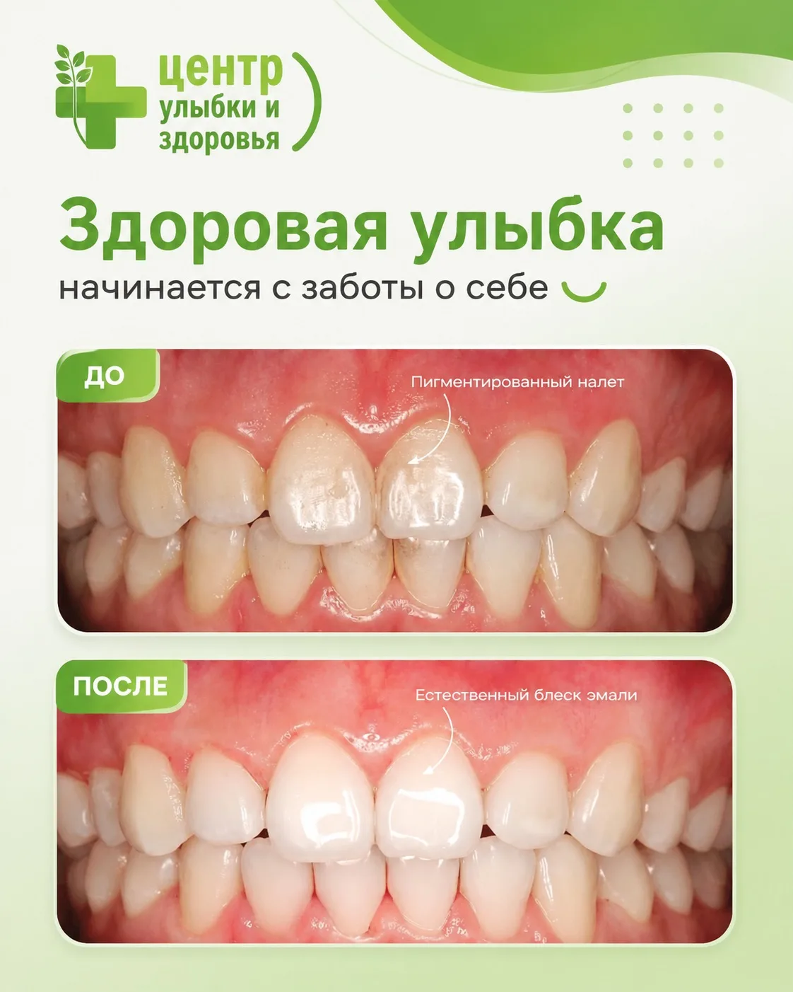 🦷 Почему профессиональная чистка зубов нужна даже тем, кто тщательно чистит зубы дома?

Многие счит