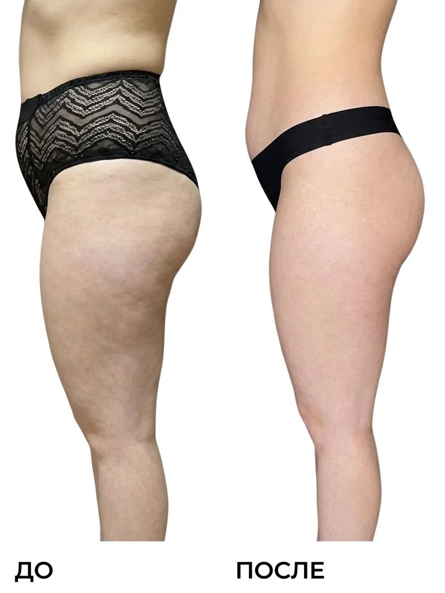 Vela Shape, кавитация или RF-лифтинг? Что выбрать для идеального тела?