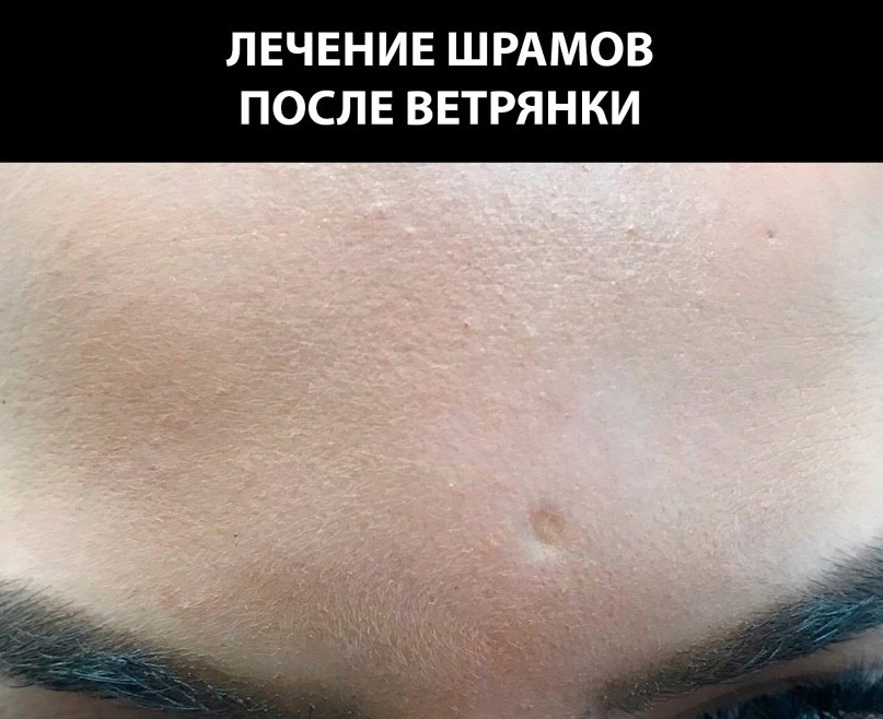 ▶ Сегодня обсуждаем рубцы после ветряной оспы.

💁 Течение ветрянки сопровождается образованием хара