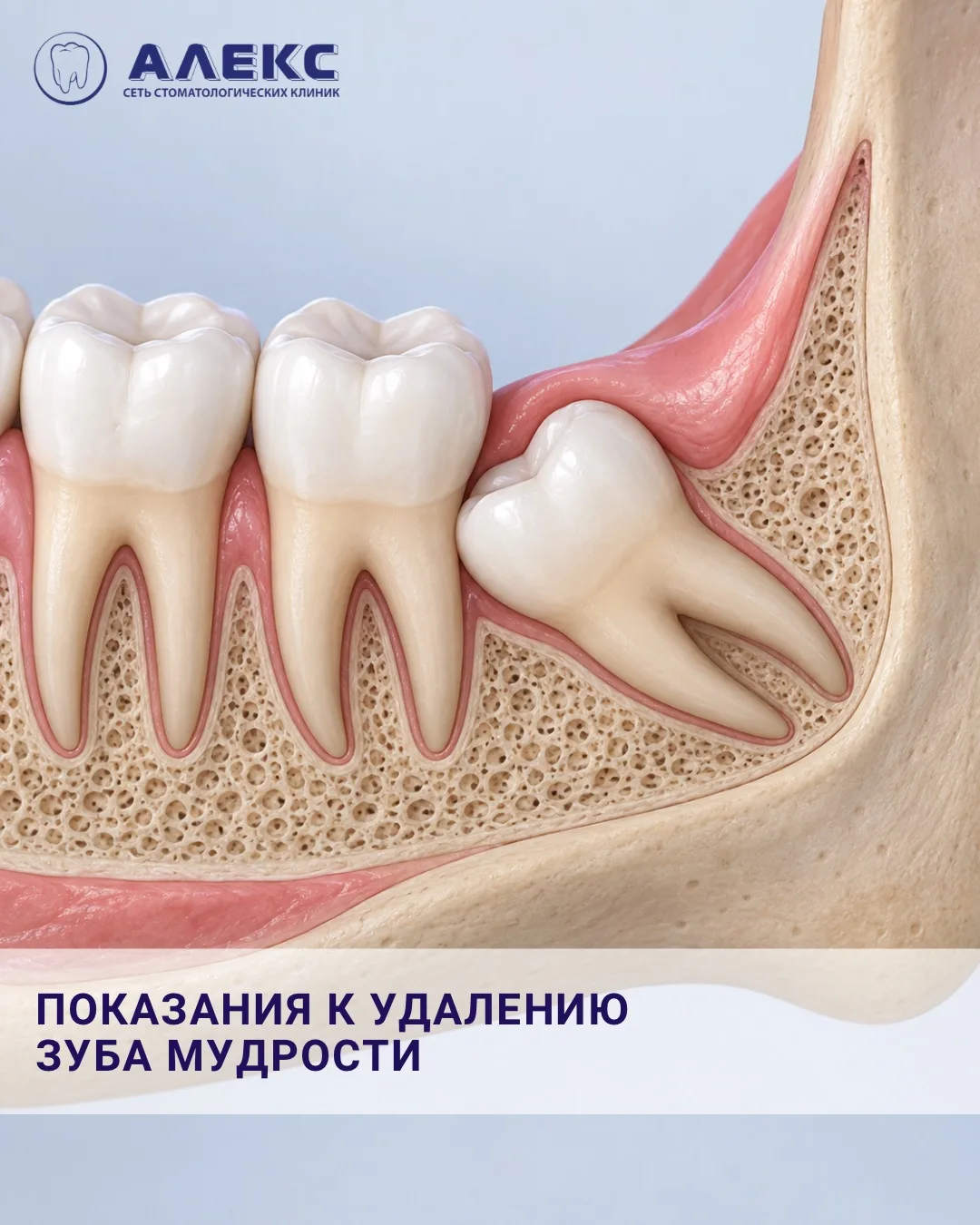 Зуб мудрости не всегда нужно удалять. Но есть ситуации, когда его сохранение может прин...